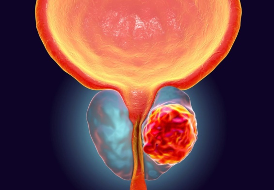 The Future of Men’s Health: How New Technology is Changing the Way We Treat Prostate Cancer