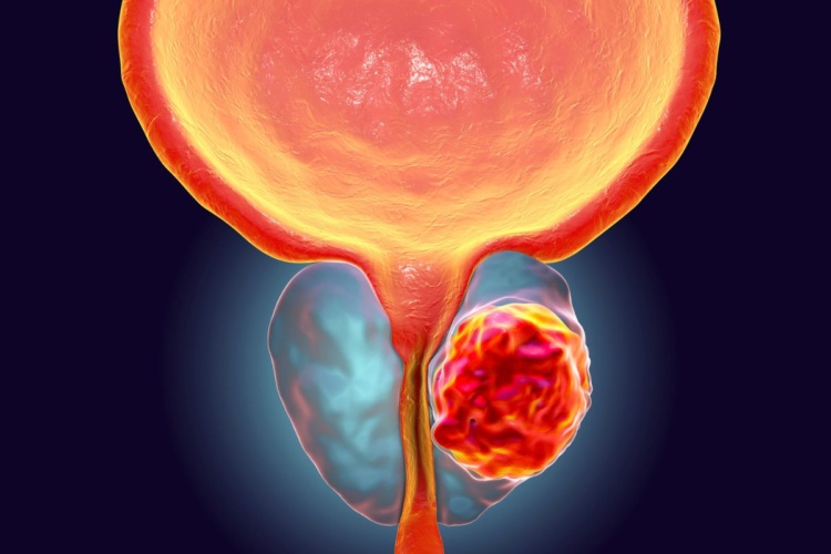 The Future of Men’s Health: How New Technology is Changing the Way We Treat Prostate Cancer